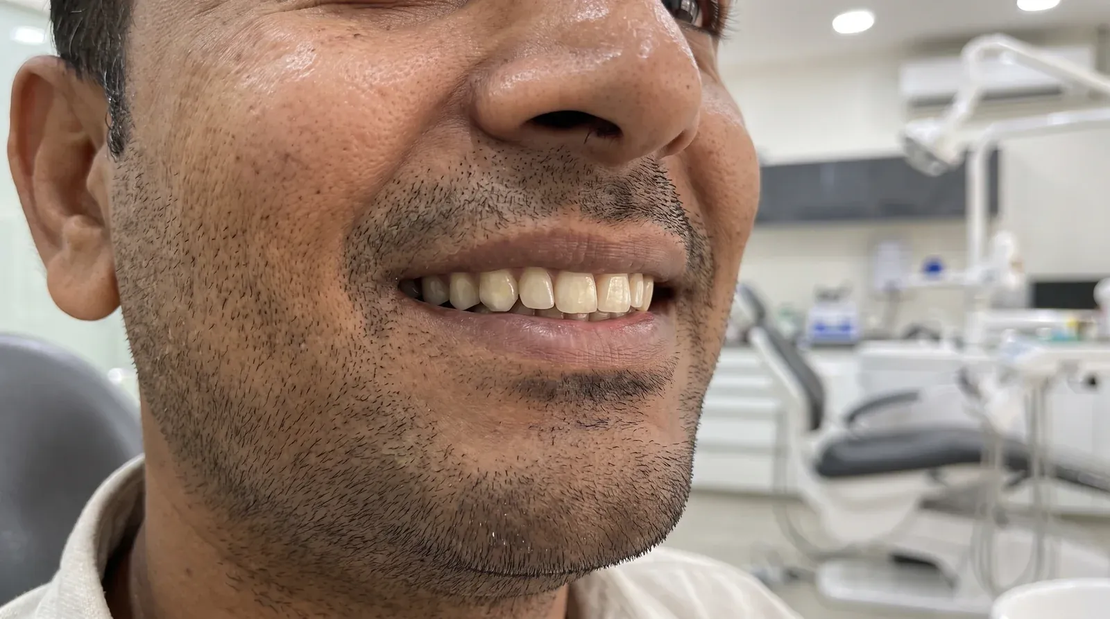 After tooth-coloured composite filling — invisible repair