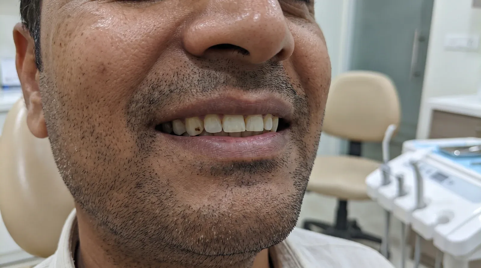 Before filling — visible cavity on a molar