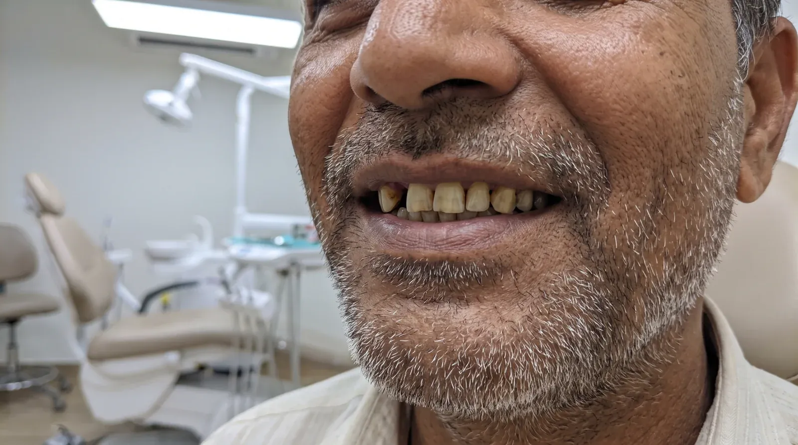 Before implant treatment — missing and worn teeth