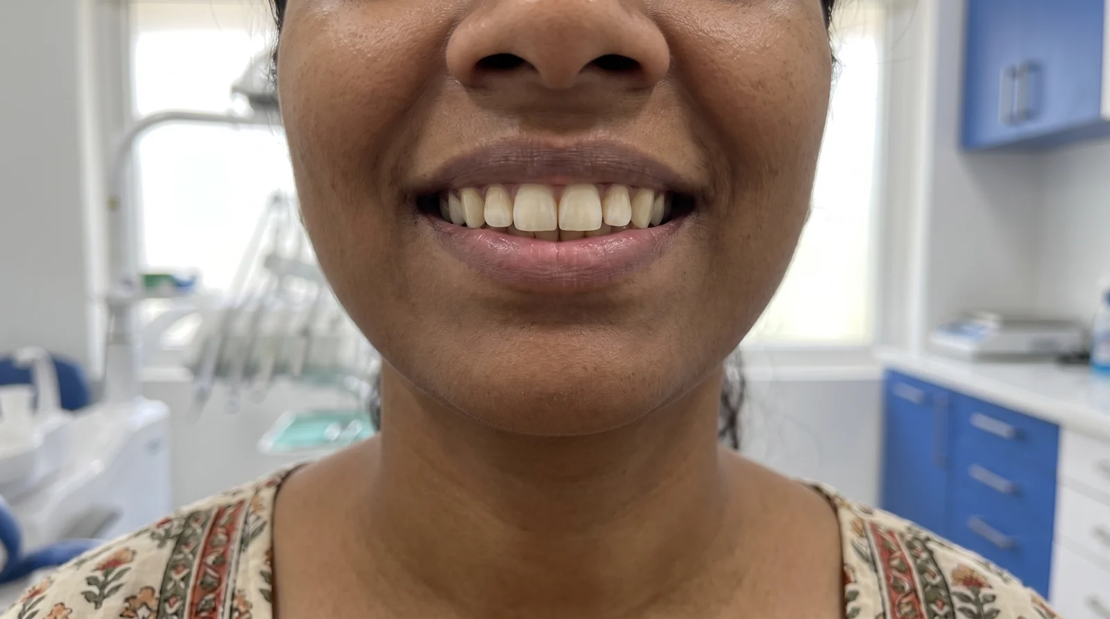 After root canal and ceramic crown — healthy natural smile