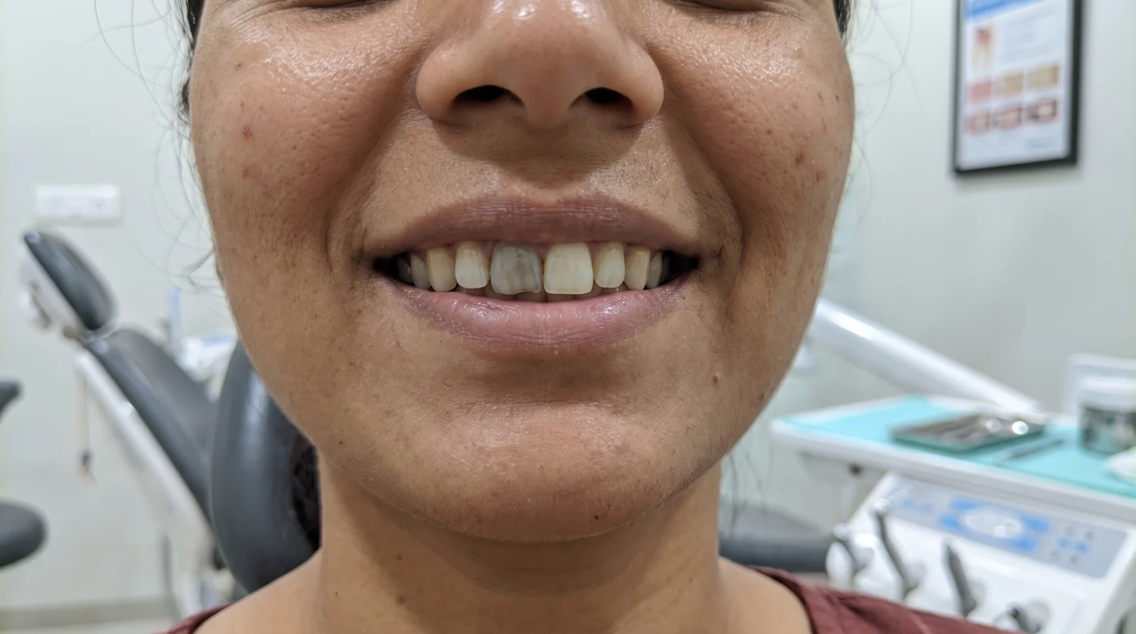 Before root canal — darkened infected front tooth