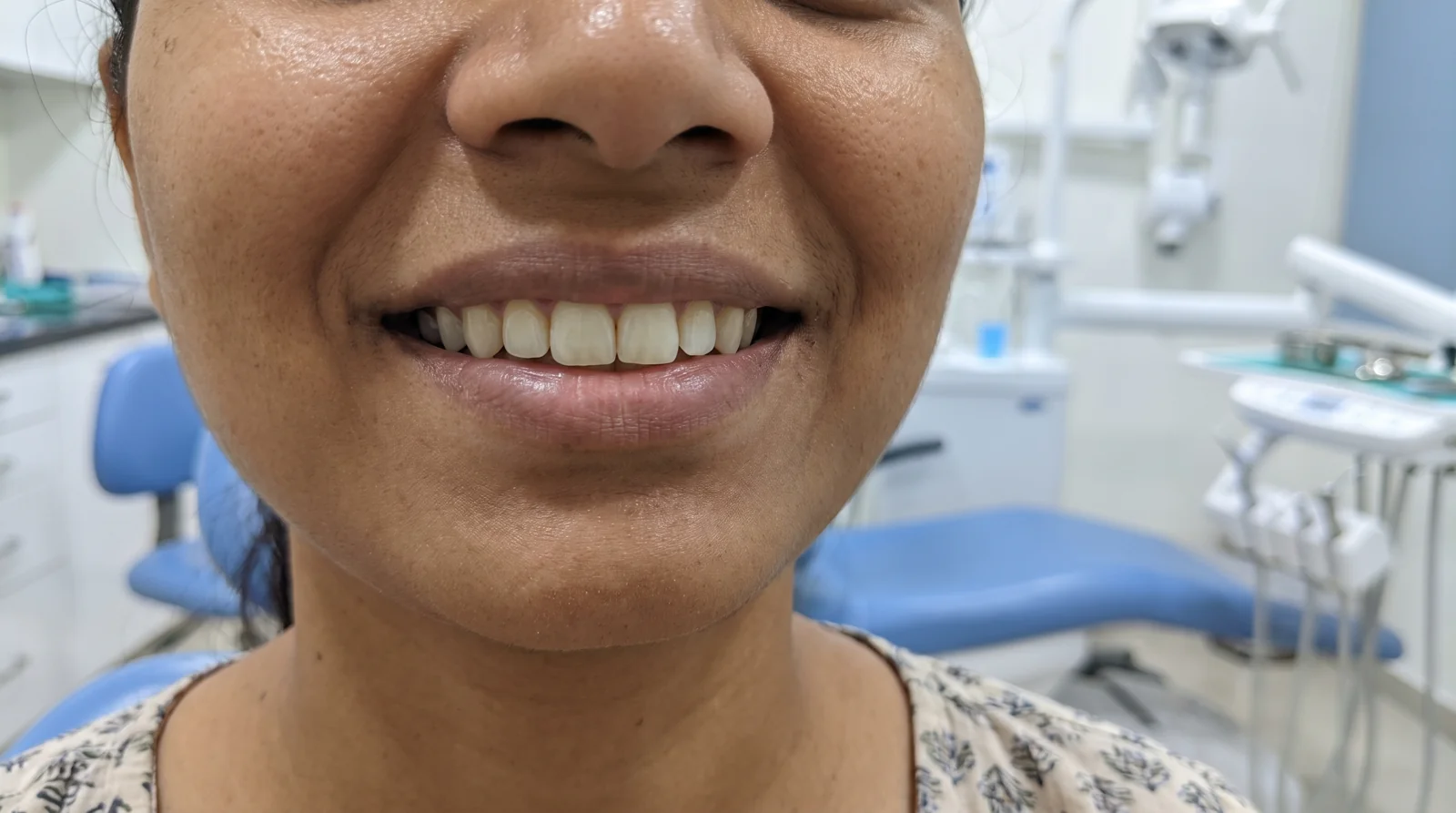 After professional teeth whitening — visibly brighter smile