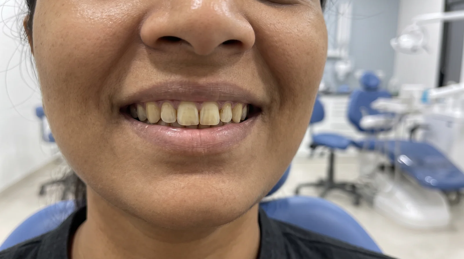 Before whitening — tea and tobacco stained teeth