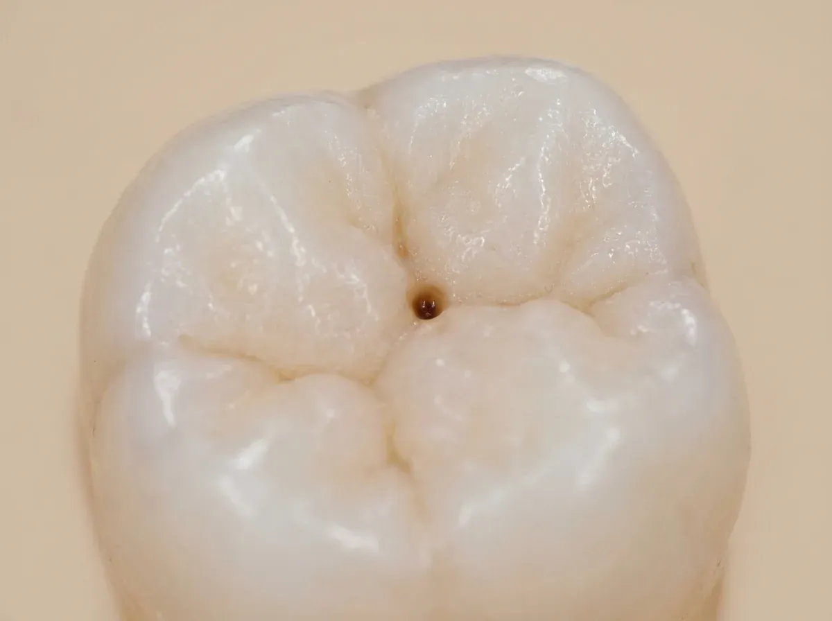 Close-up of a small dark cavity on a tooth before composite filling