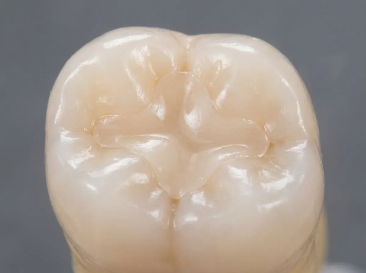 Invisible tooth-coloured composite filling restoration