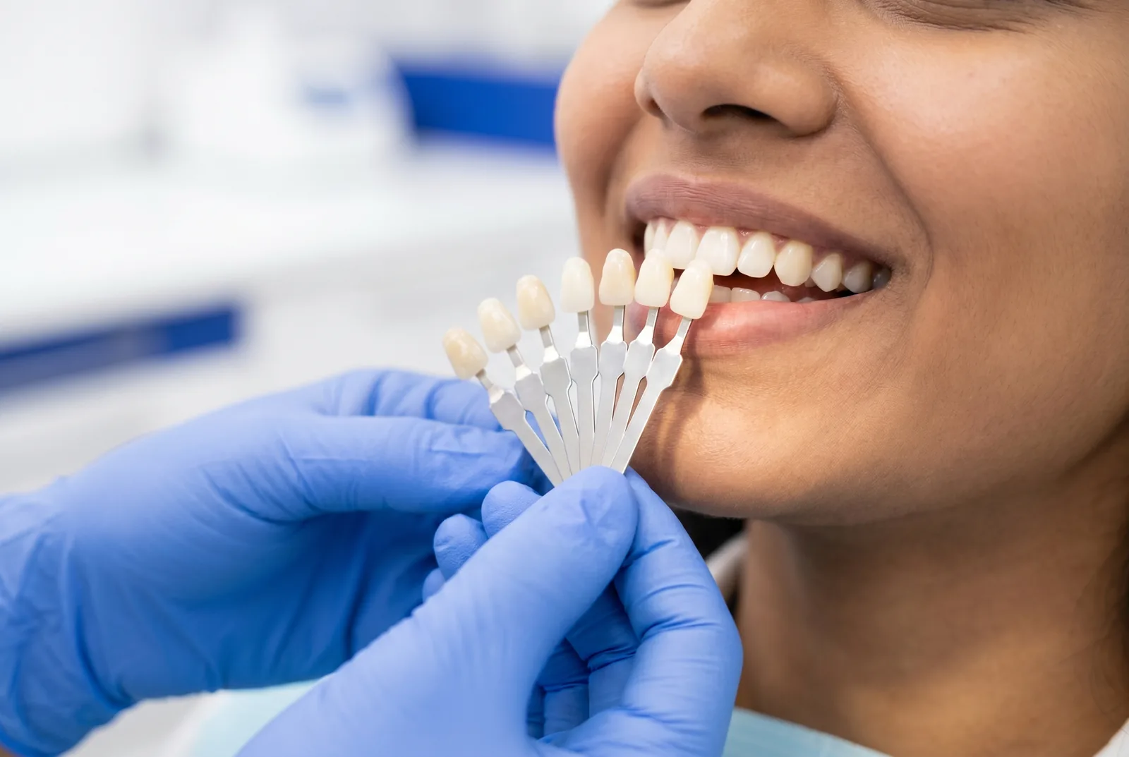 Shade-matching a natural tooth-colored composite restoration
