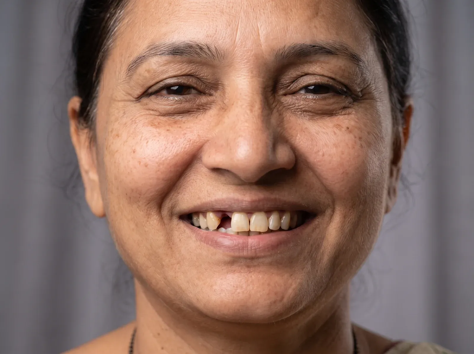 Smile with a visible missing tooth gap before a dental implant