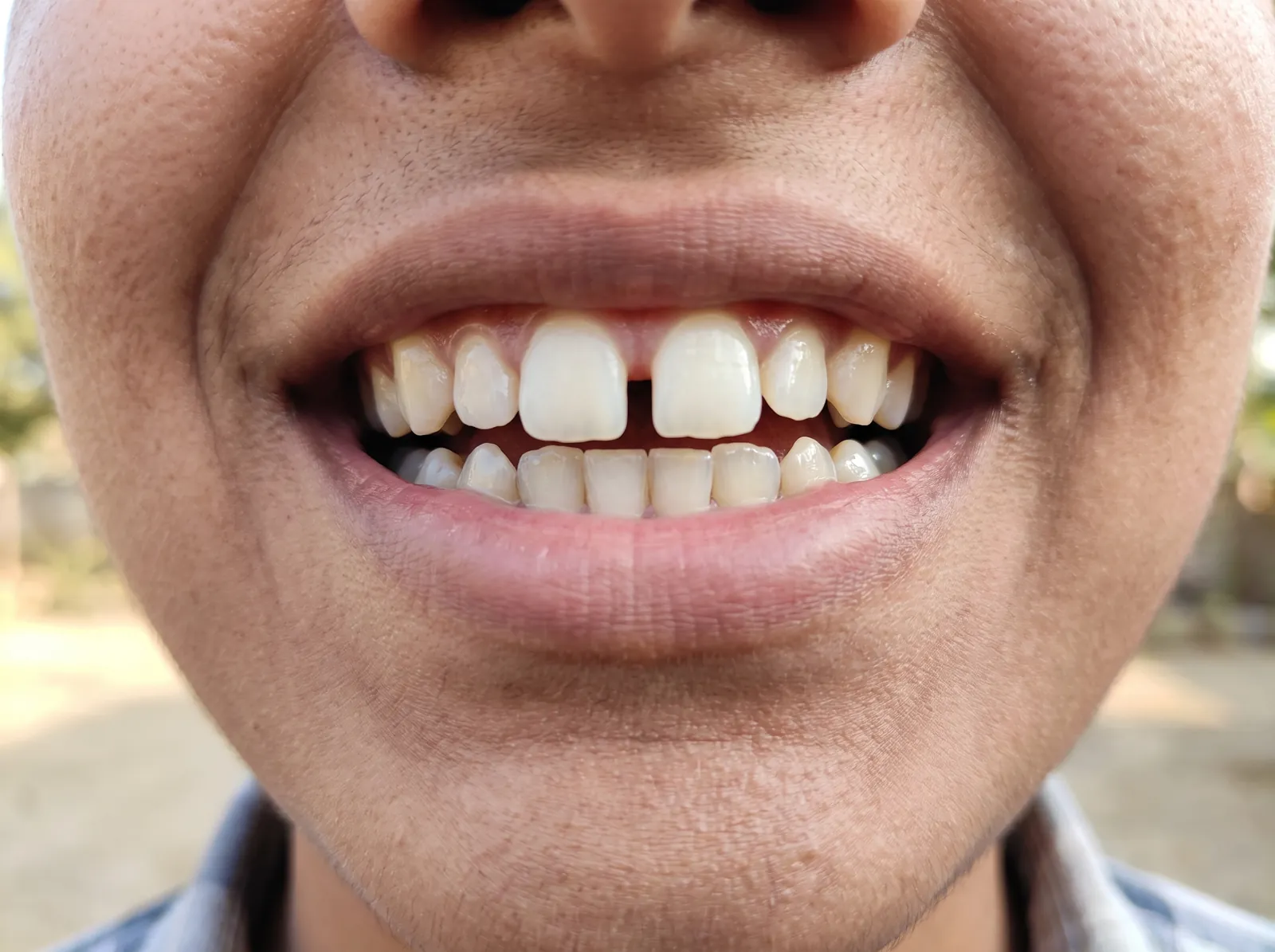 Smile with a gap between the front teeth and crowded, crooked side teeth before orthodontic treatment