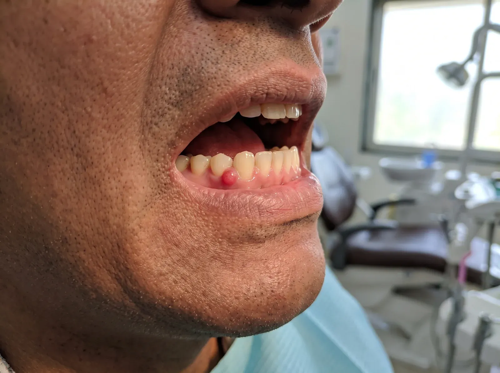 Gum swelling from a reinfected, previously treated tooth