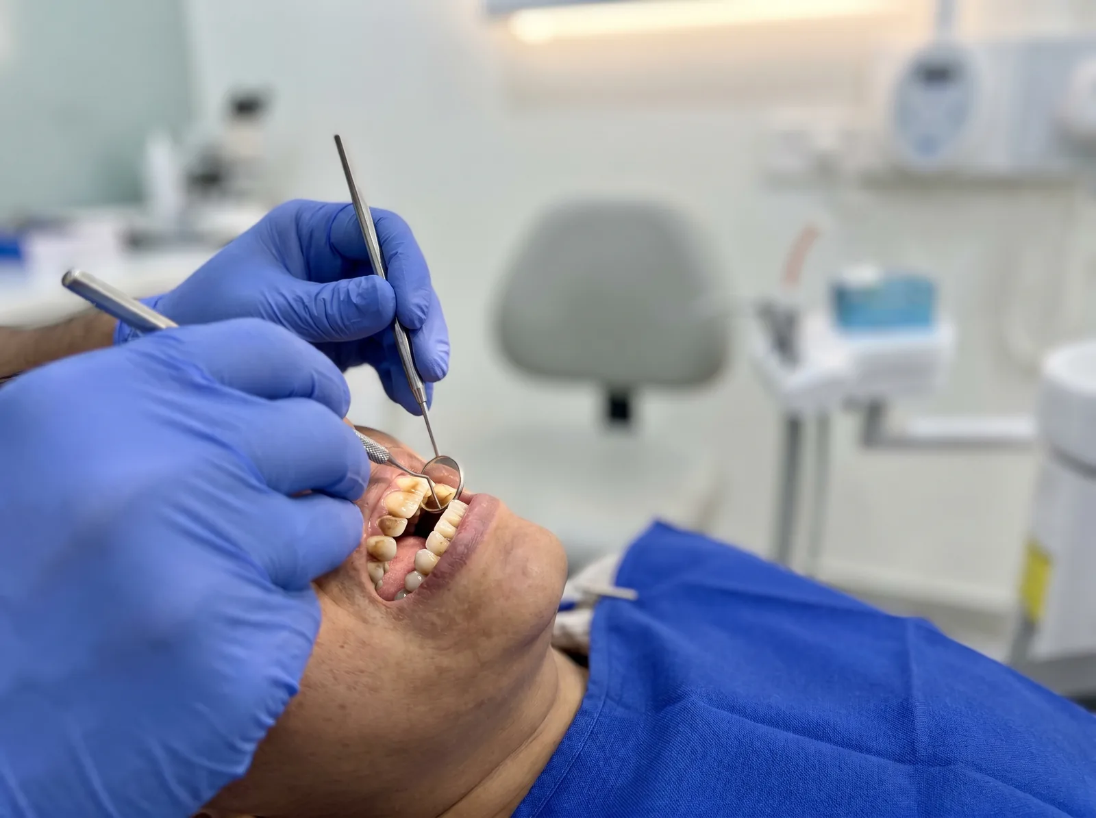 Yellowed, stained teeth before professional whitening